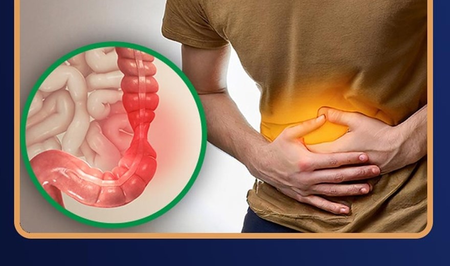 سندرم روده تحریک‌پذیر(IBS)